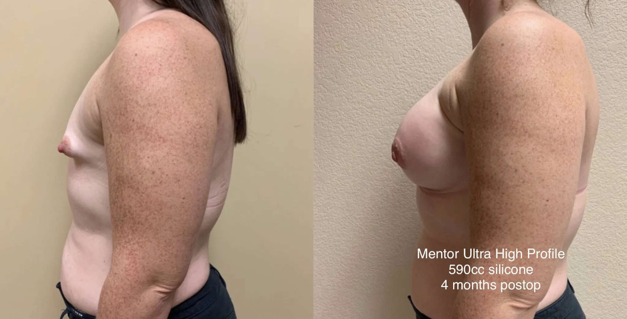 TUBEROUS BREAST AUGMENTATION Before & After Case Number 0001