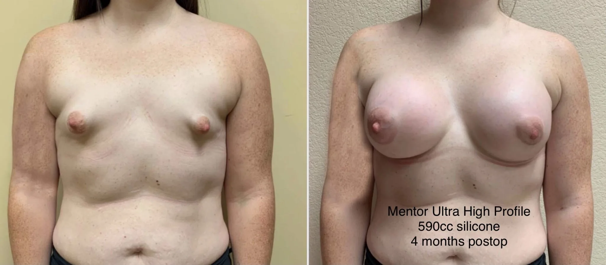 TUBEROUS BREAST AUGMENTATION Before & After Case Number 0001