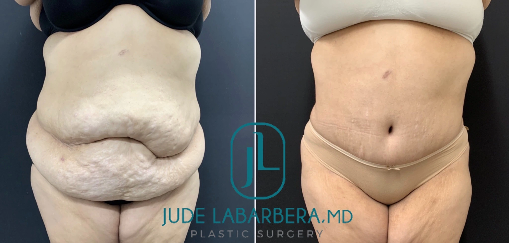 High BMI Tummy Tuck Before & After case 266