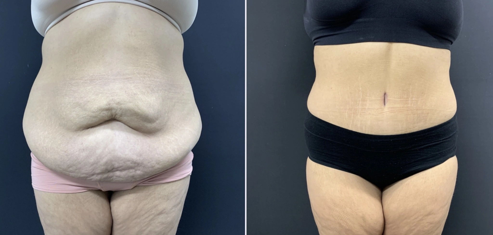 High BMI Tummy Tuck Before & After case 266