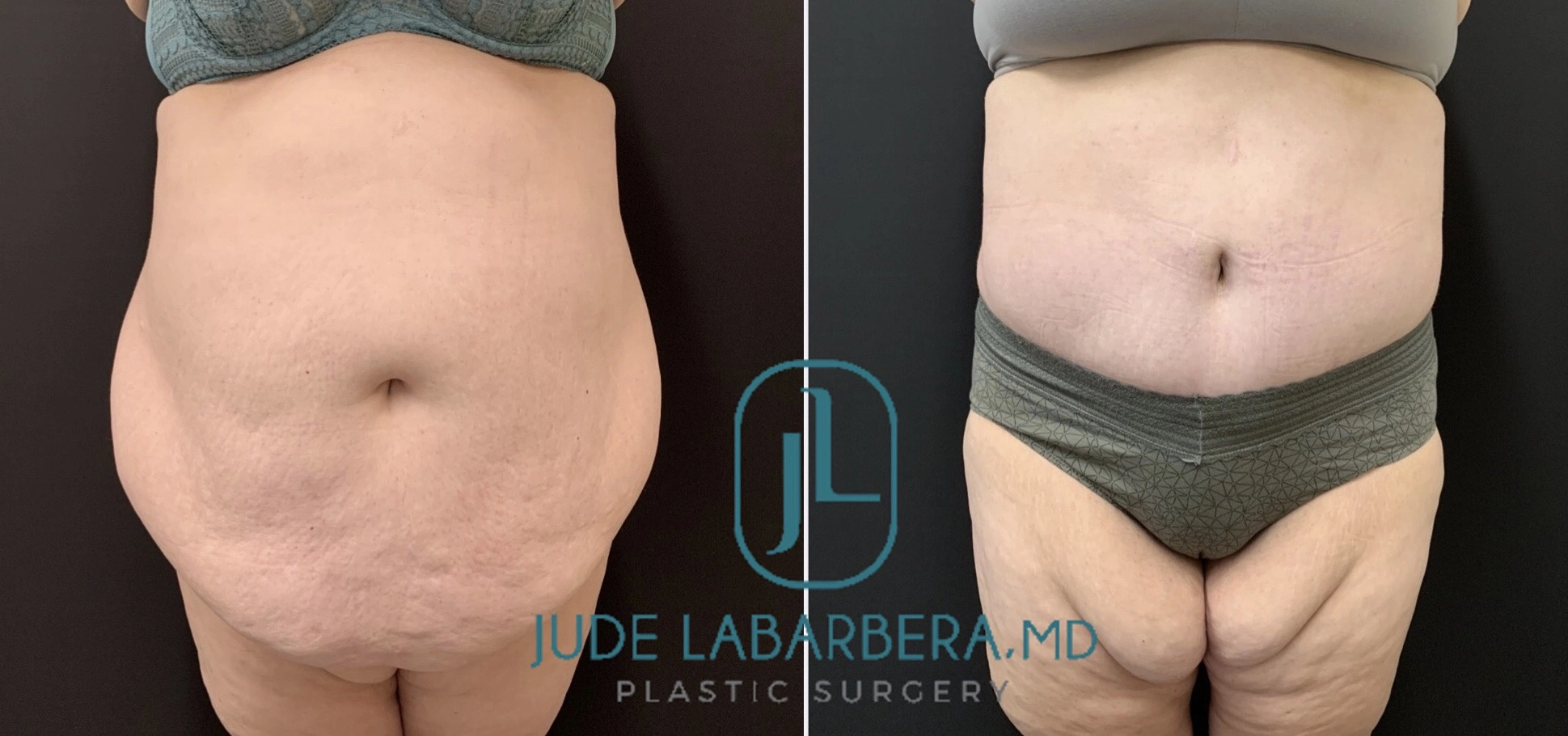 High BMI Tummy Tuck Before & After case 266