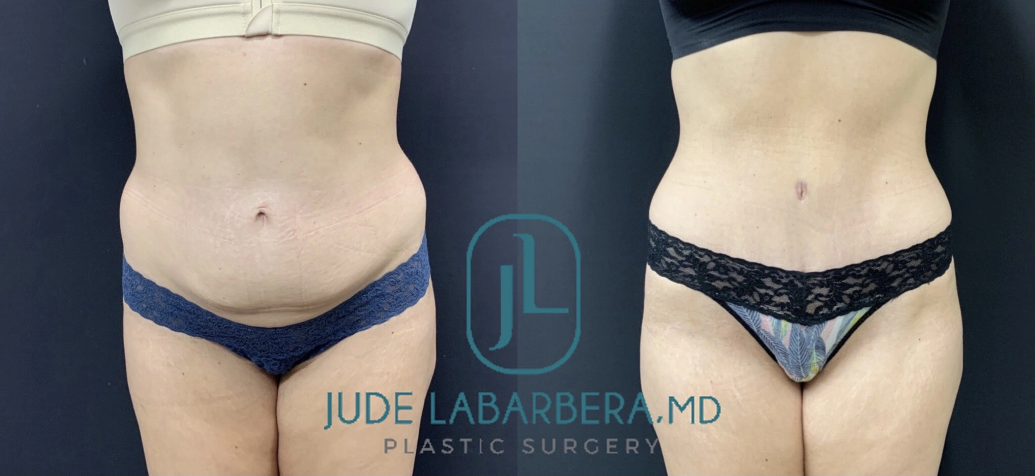 TUMMY TUCK Before & After Case Number 000109