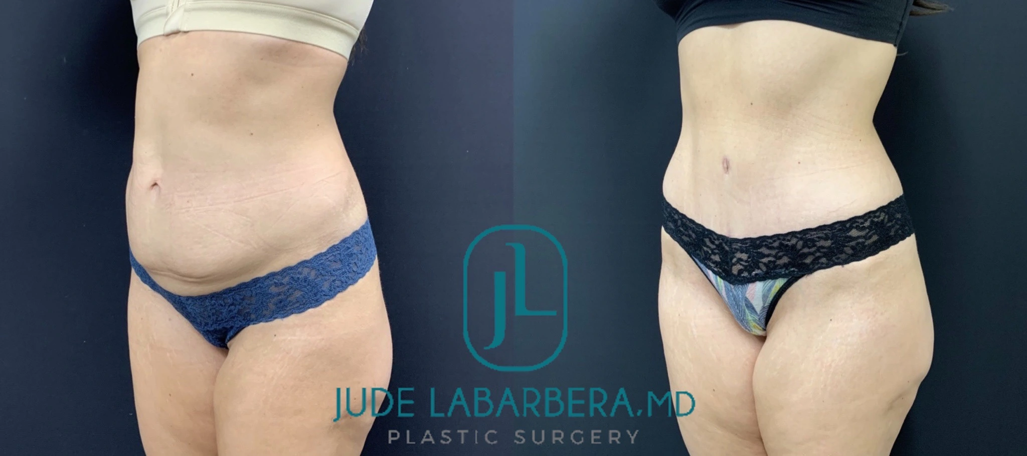 TUMMY TUCK Before & After Case Number 000109