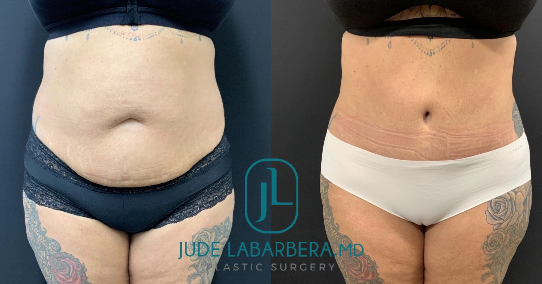 TUMMY TUCK Before & After Case Number 000110