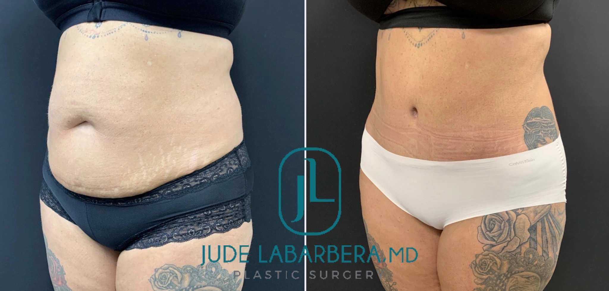 TUMMY TUCK Before & After Case Number 000110