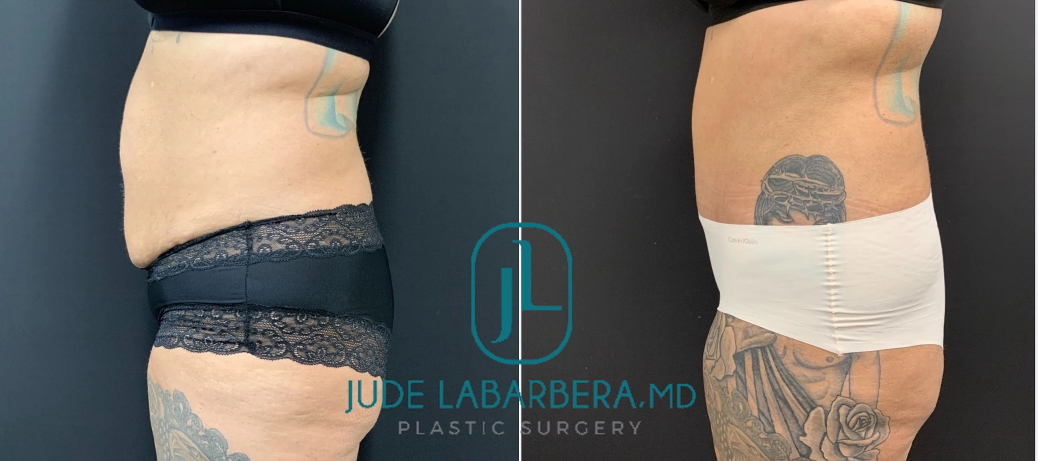 TUMMY TUCK Before & After Case Number 000110