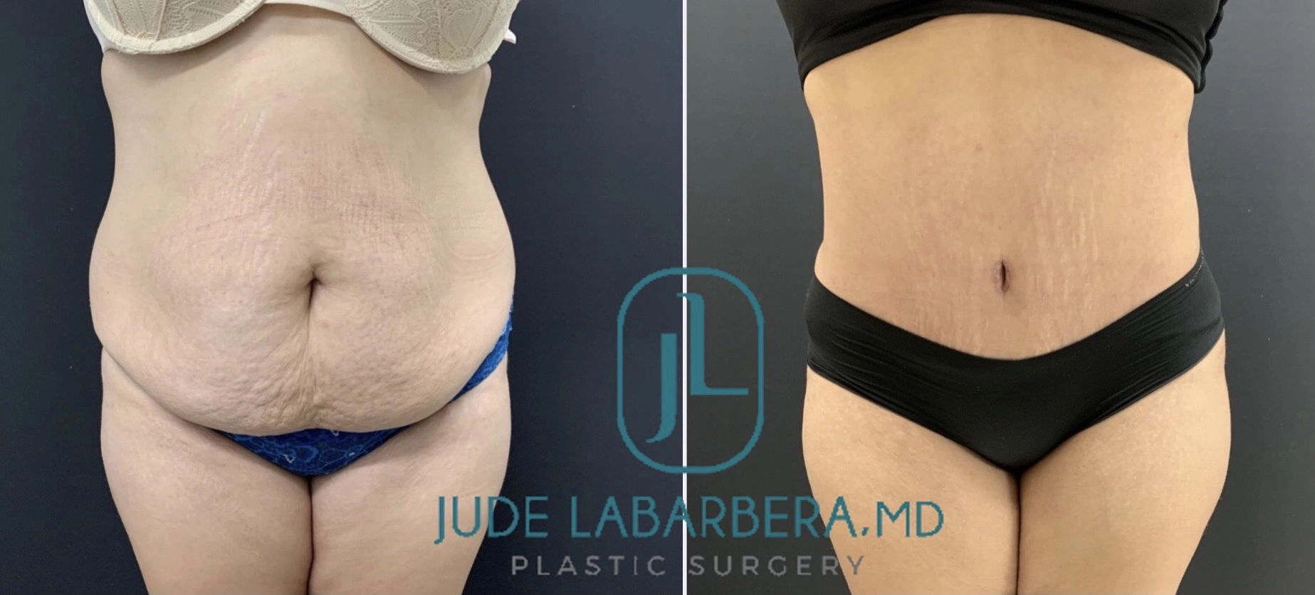 TUMMY TUCK Before & After Case Number 000111