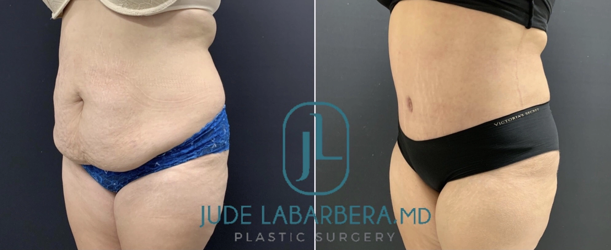 TUMMY TUCK Before & After Case Number 000111