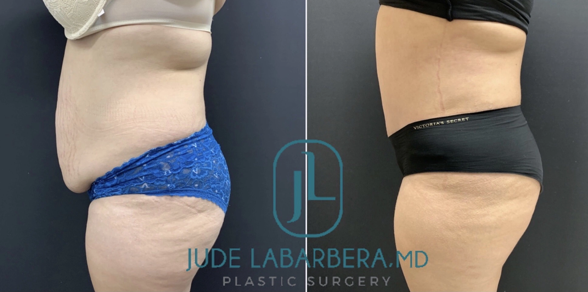 TUMMY TUCK Before & After Case Number 000111