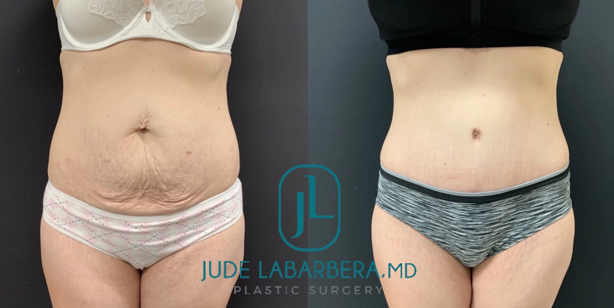 TUMMY TUCK Before & After Case Number 000113