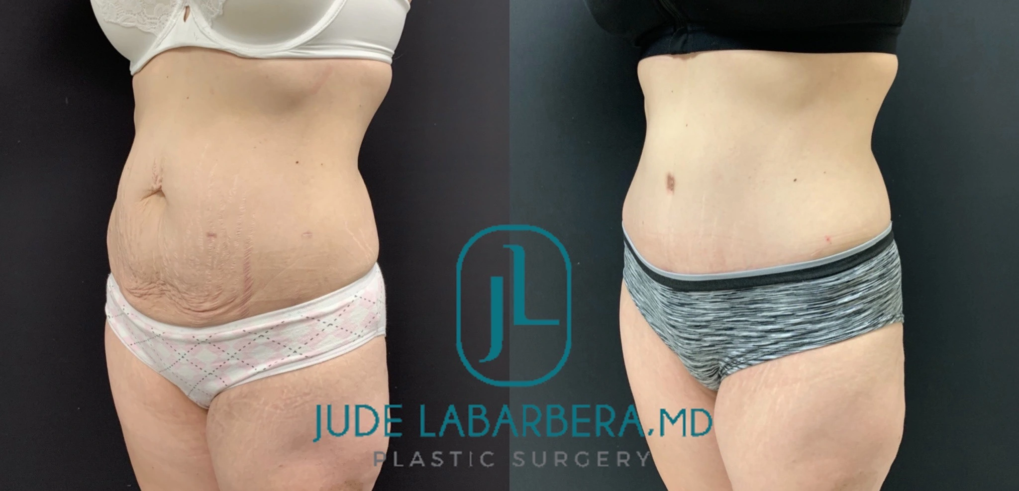 TUMMY TUCK Before & After