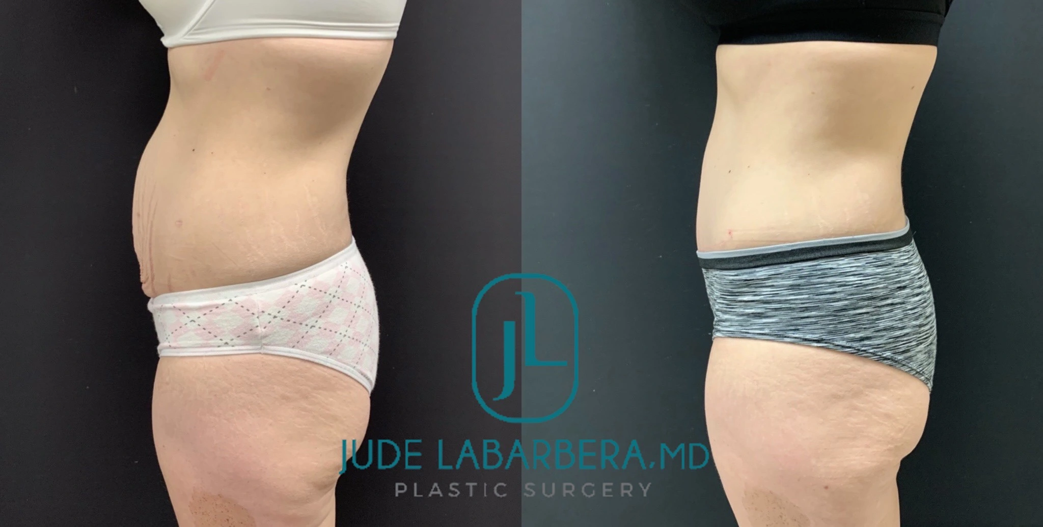 TUMMY TUCK Before & After Case Number 000113