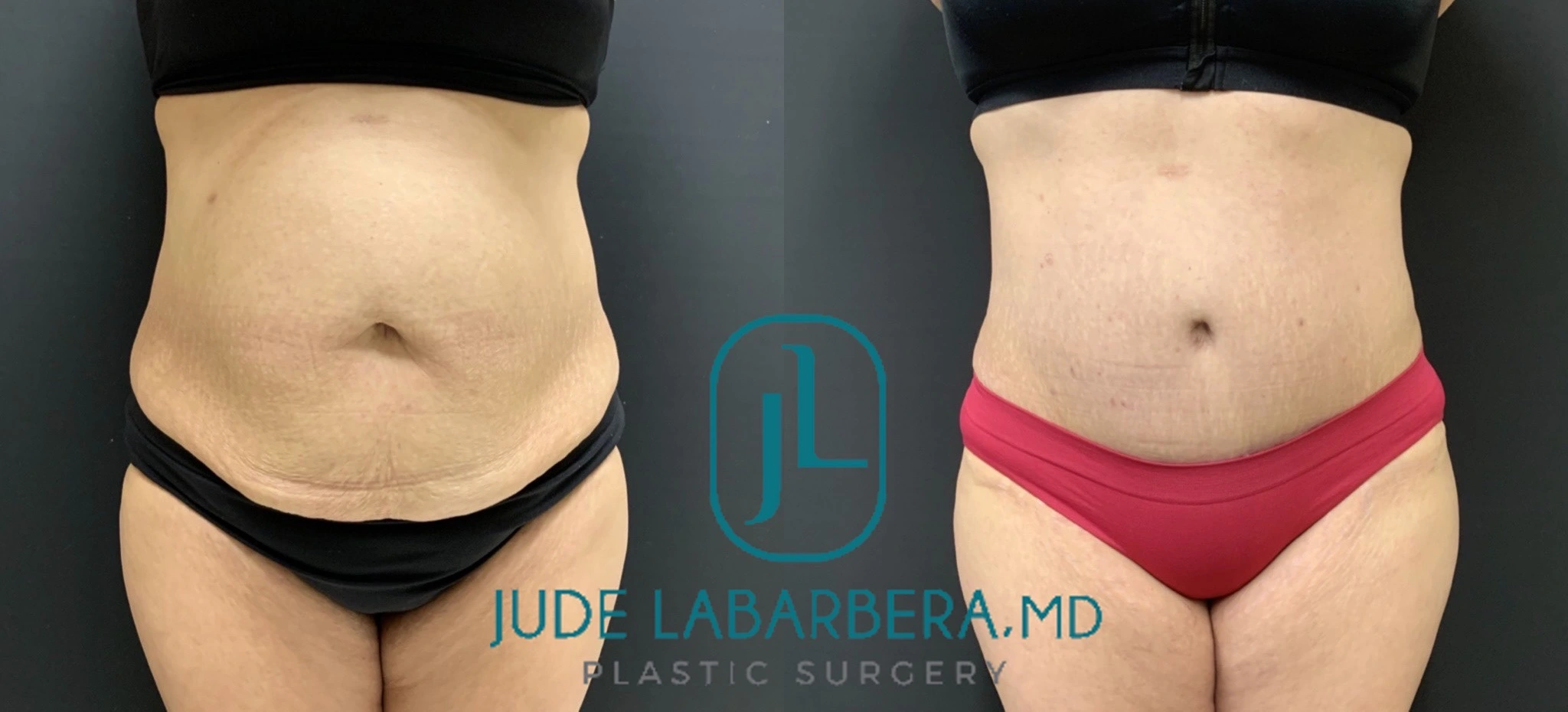 Tummy Tuck Before & After Case Number 00012