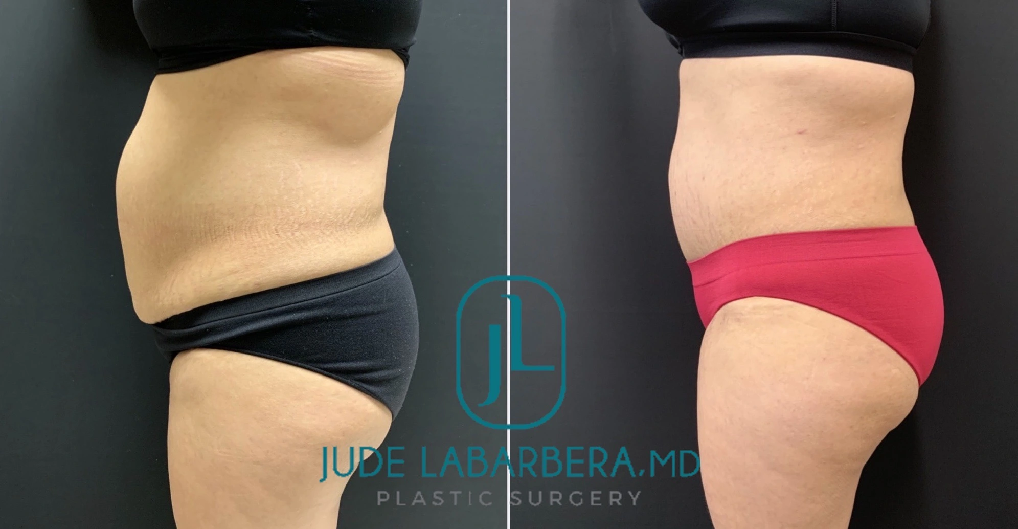 Tummy Tuck Before & After Case Number 00012