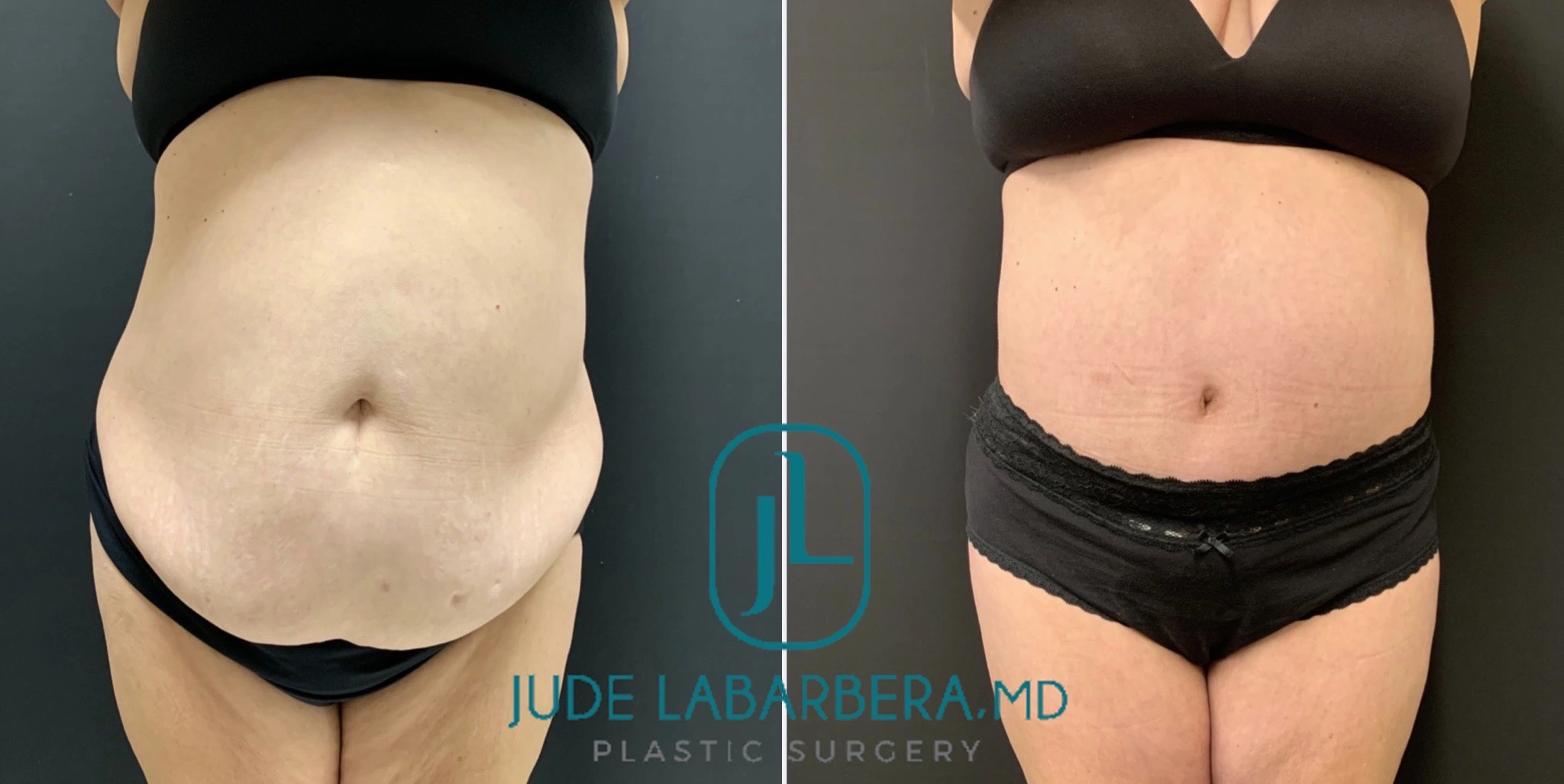 Tummy Tuck Before & After Case Number 00012