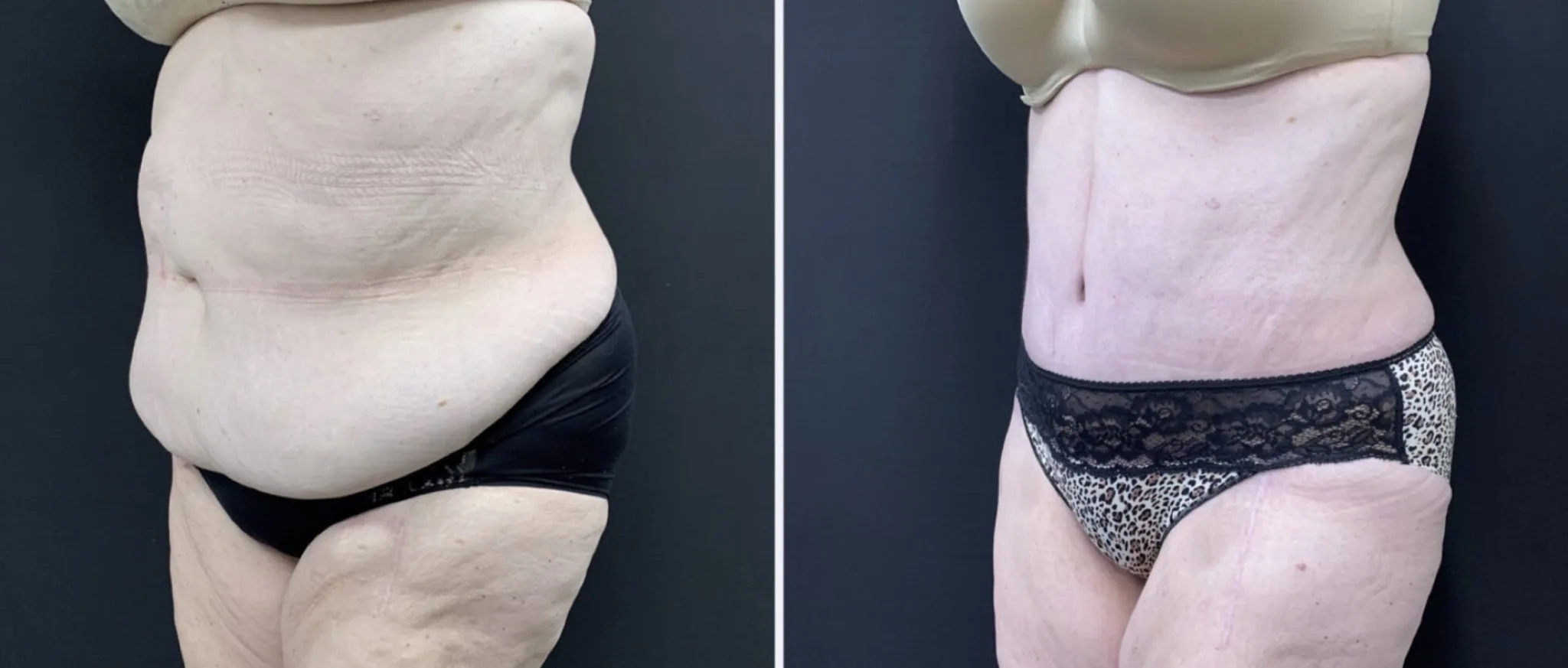 Tummy Tuck Before & After Case Number 00016