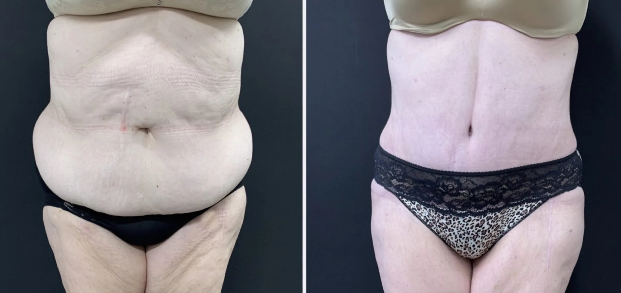 Tummy Tuck Before & After Case Number 00016