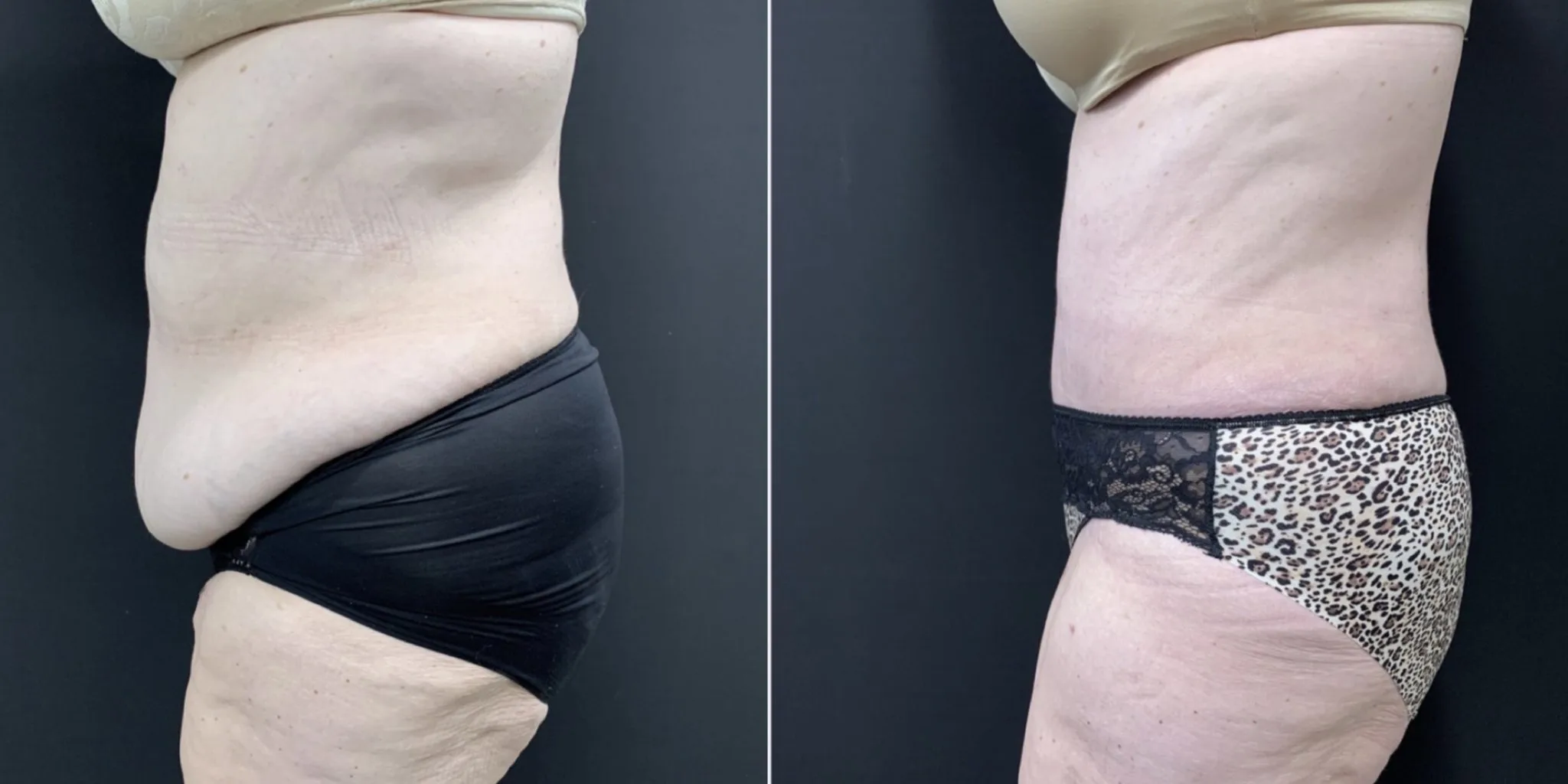 Tummy Tuck Before & After Case Number 00016