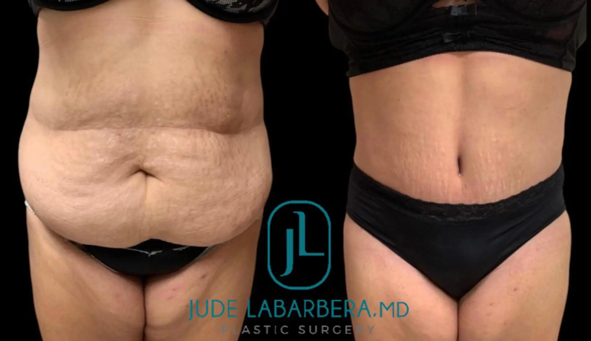 Tummy Tuck Before & After Case Number 00017