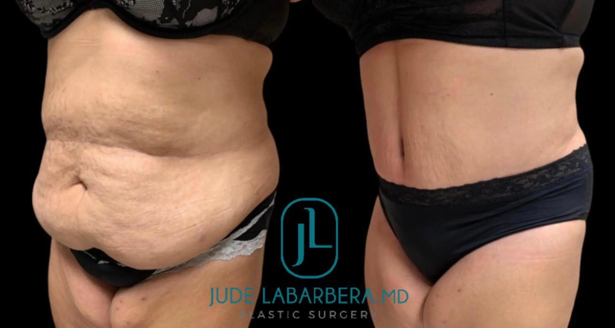 Tummy Tuck Before & After Case Number 00017