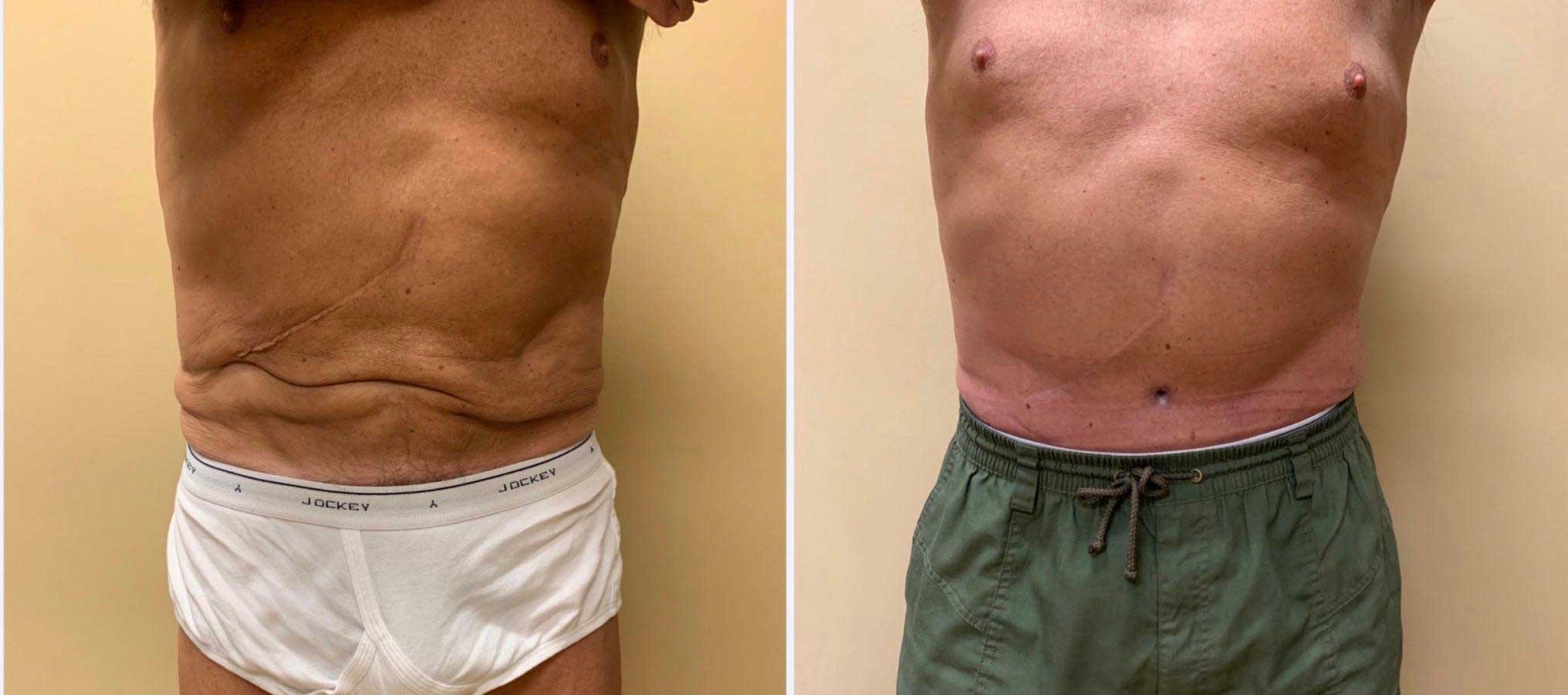 Tummy Tuck Before & After Case Number 00018