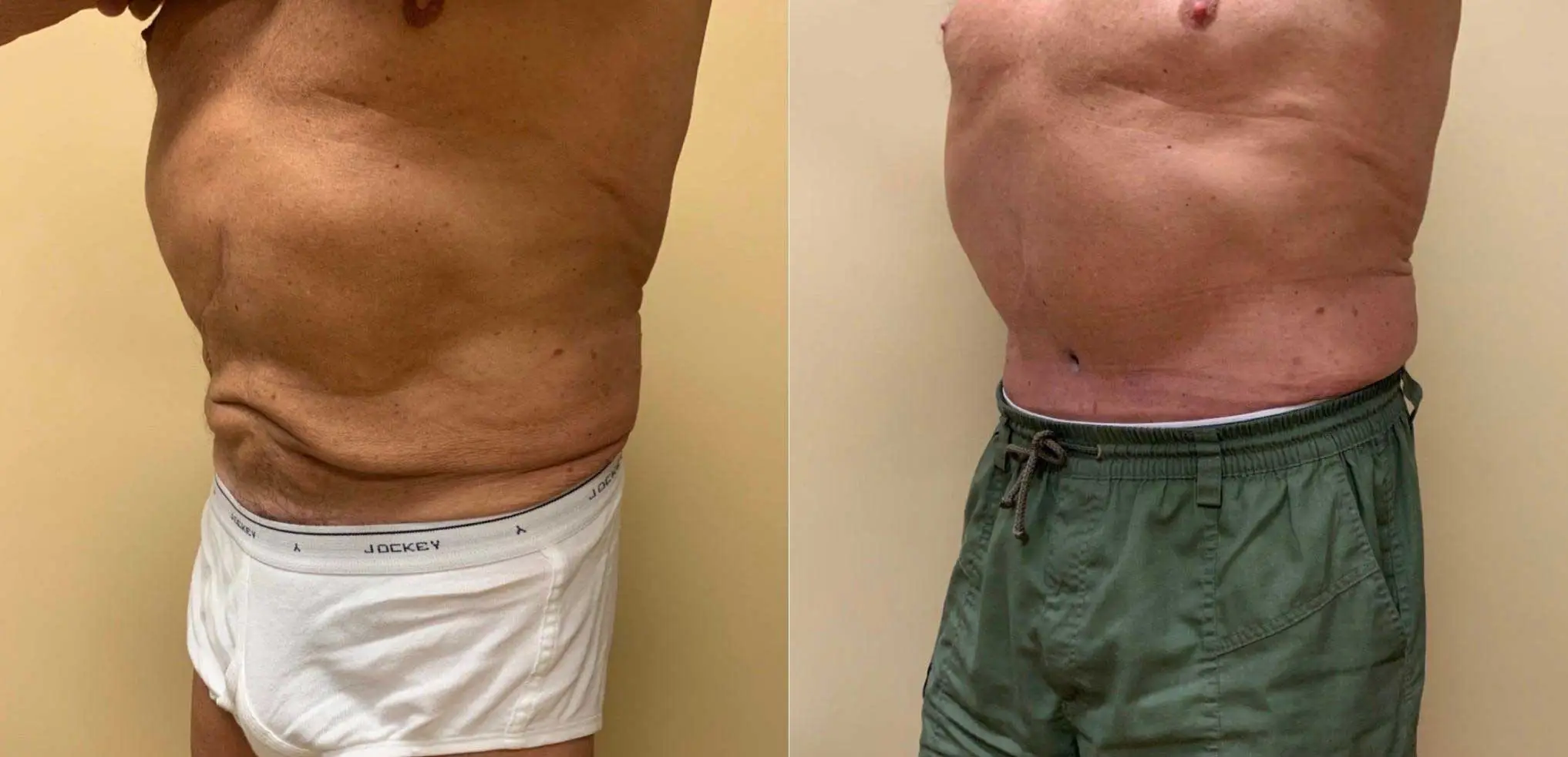 Tummy Tuck Before & After Case Number 00018