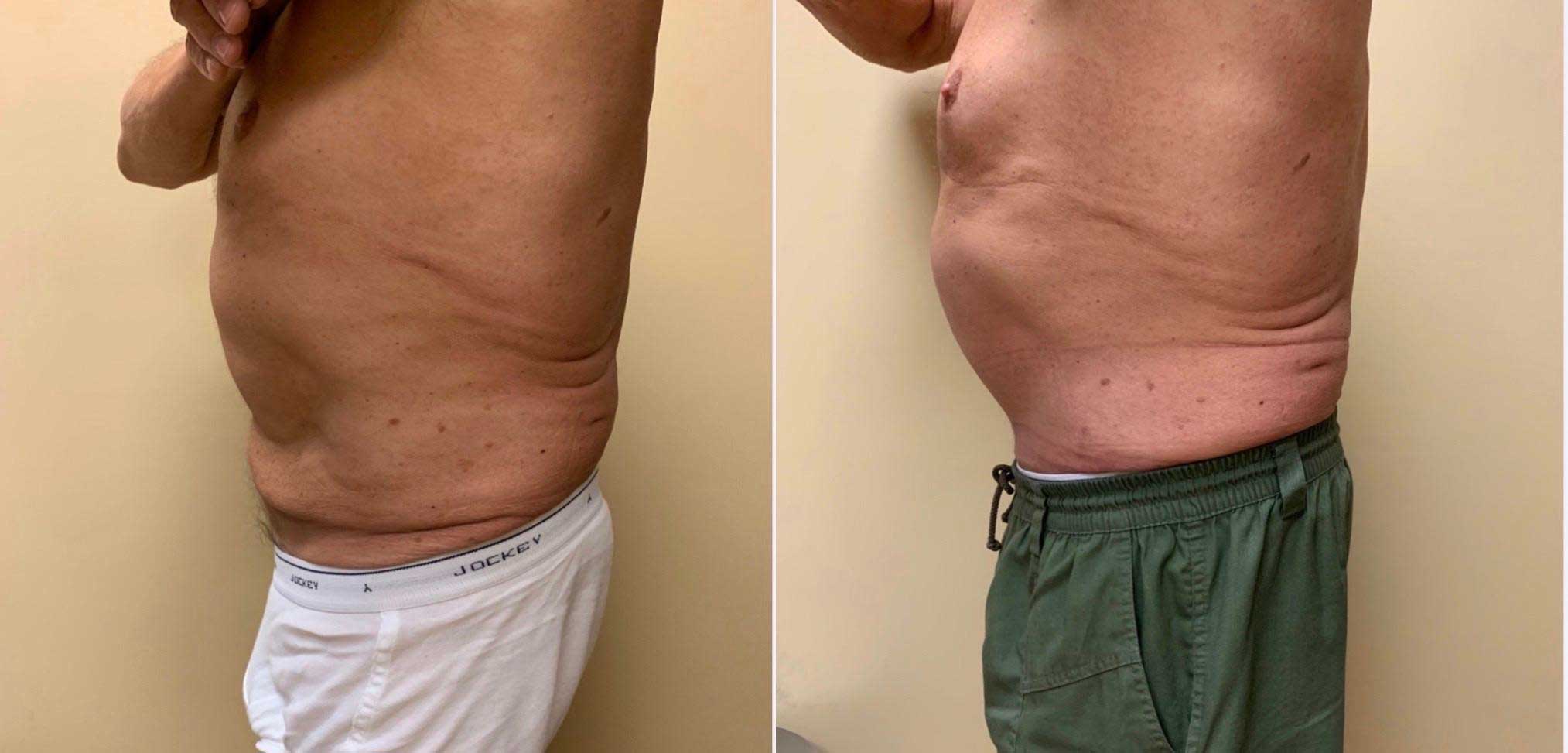 Tummy Tuck Before & After Case Number 00018