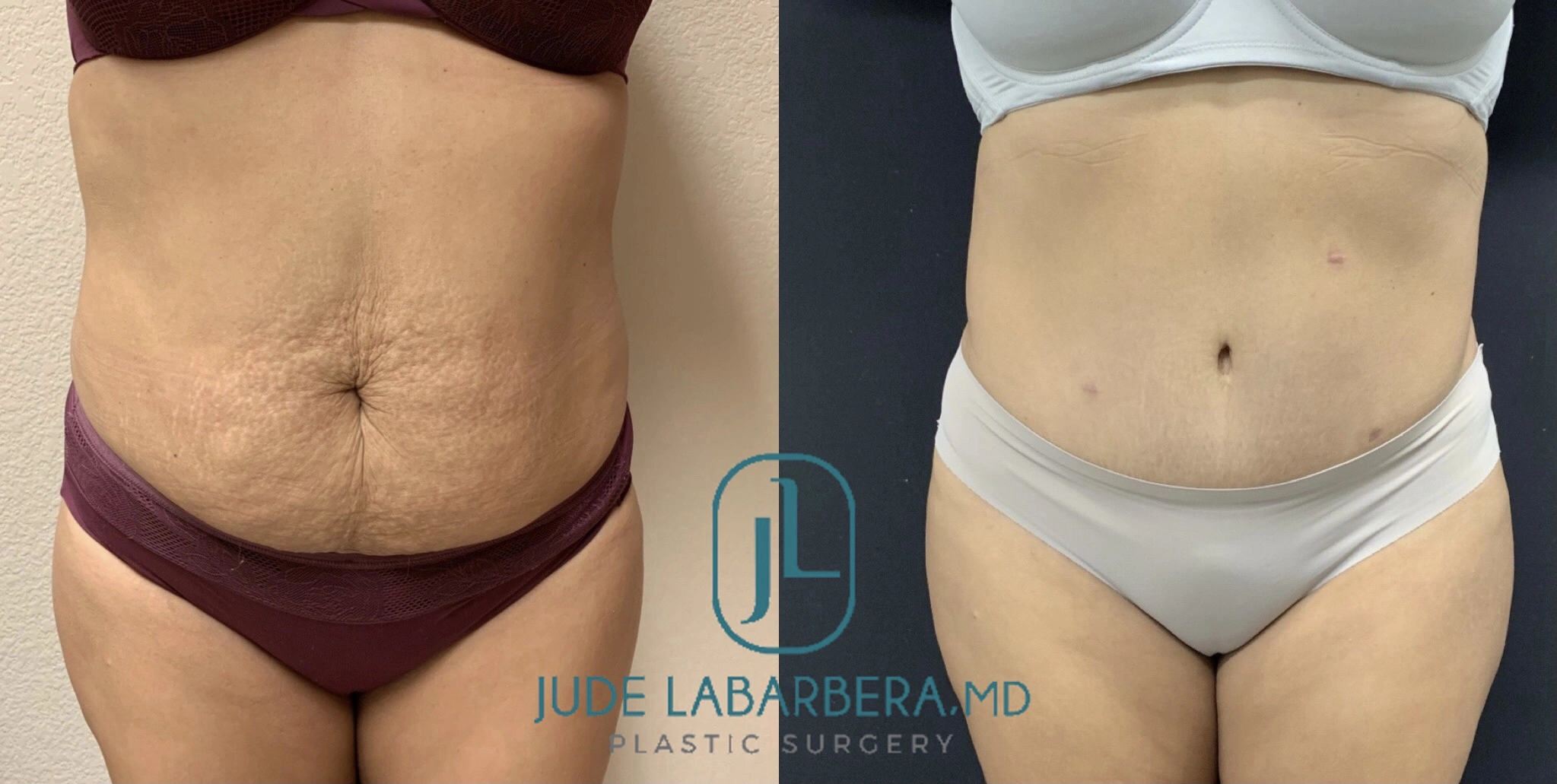 Tummy Tuck Before & After Case Number 00022
