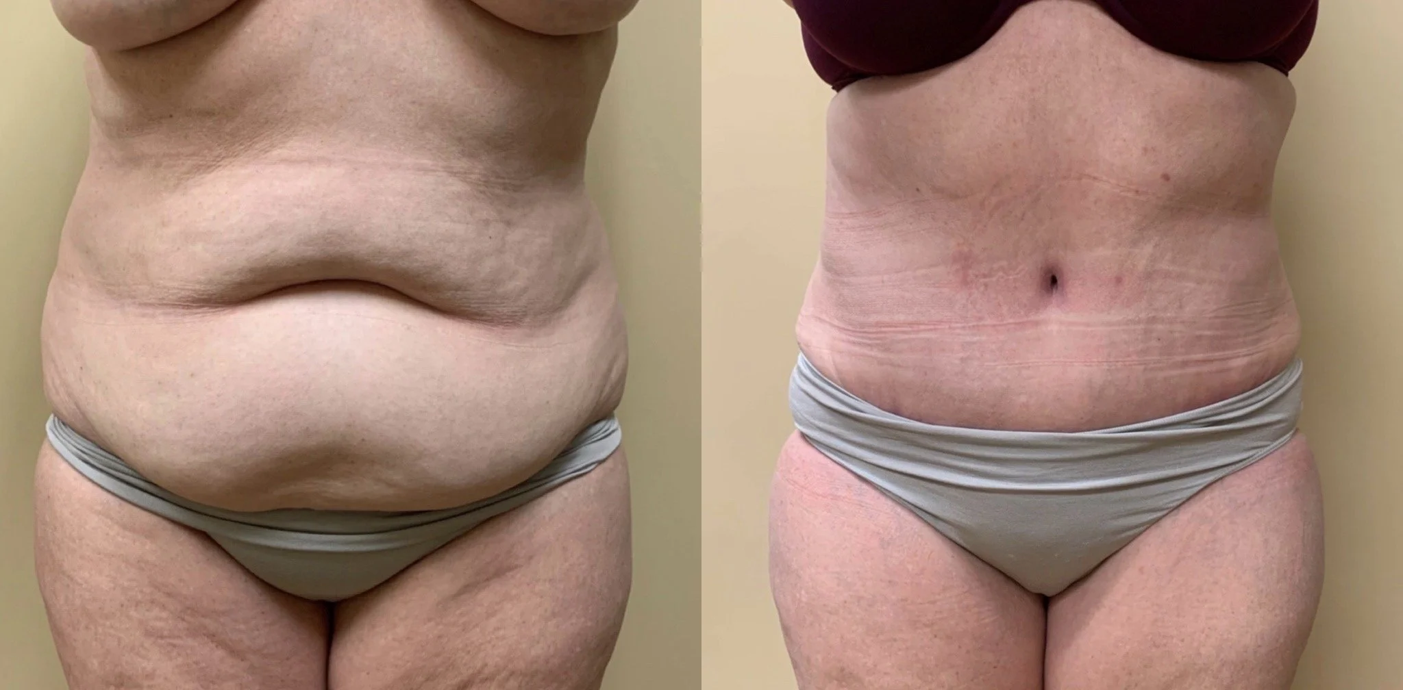Tummy Tuck Before & After Case Number 00023