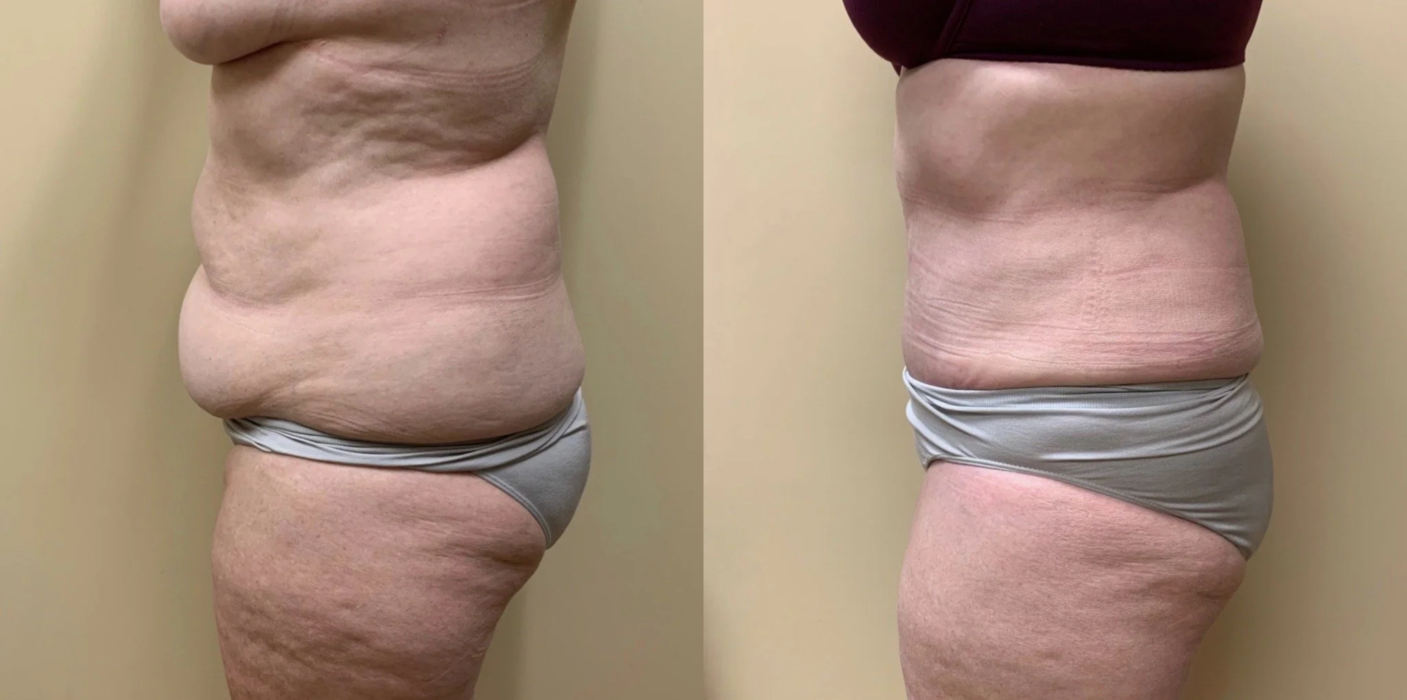 Tummy Tuck Before & After Case Number 00023