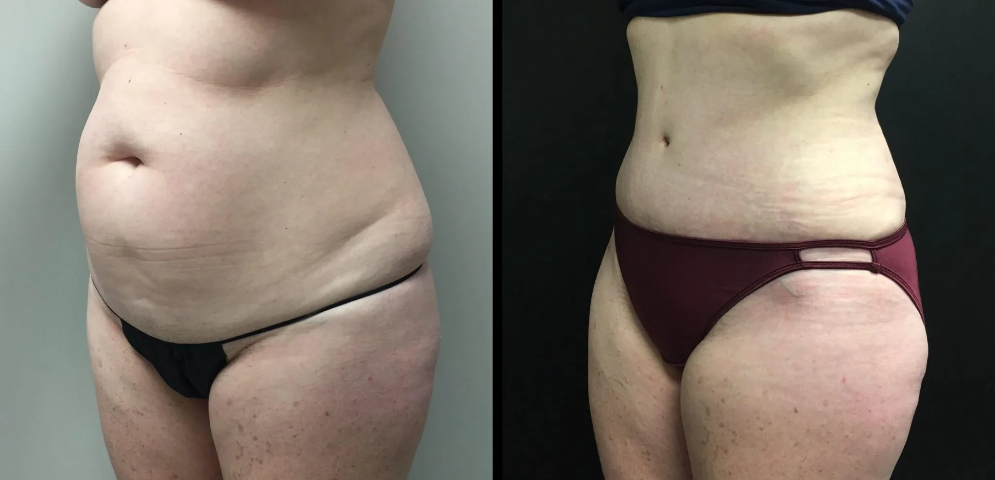 Tummy Tuck Before & After Case Number 00025