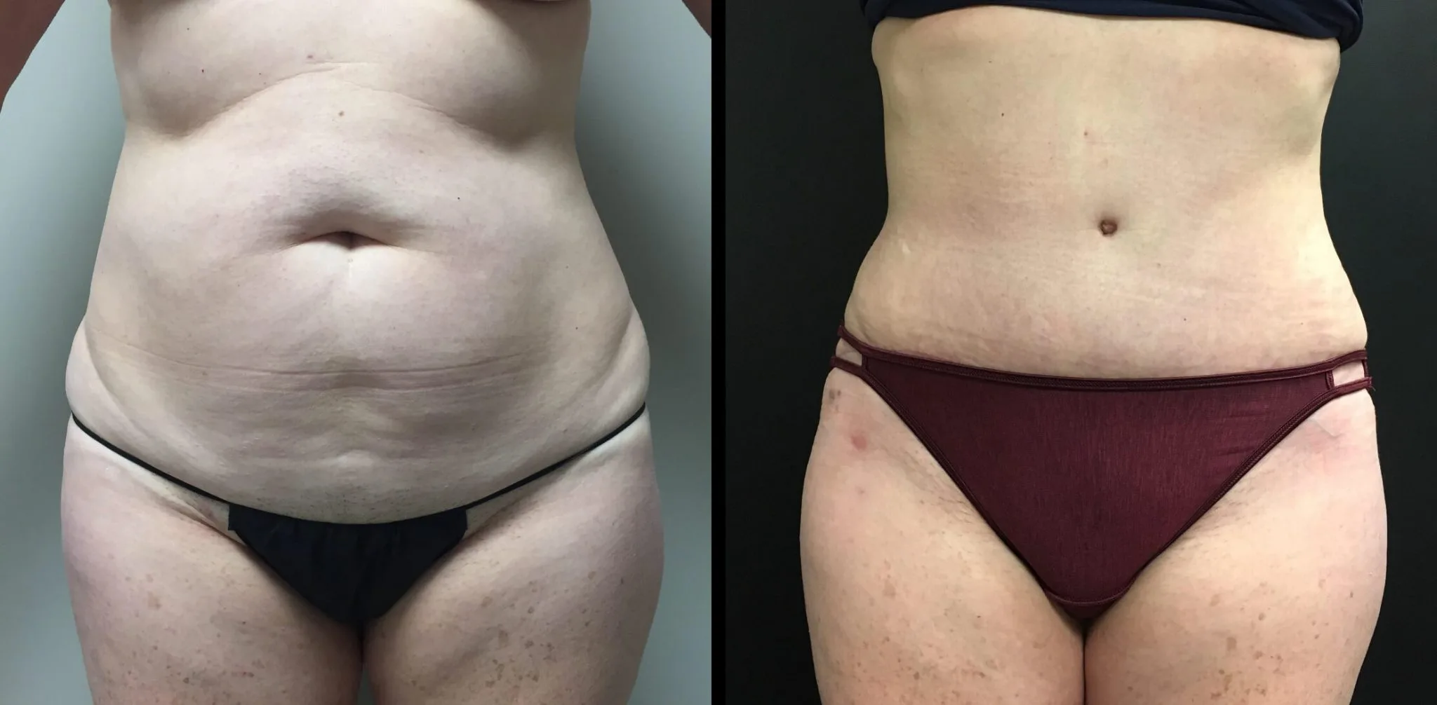 Tummy Tuck Before & After Case Number 00025