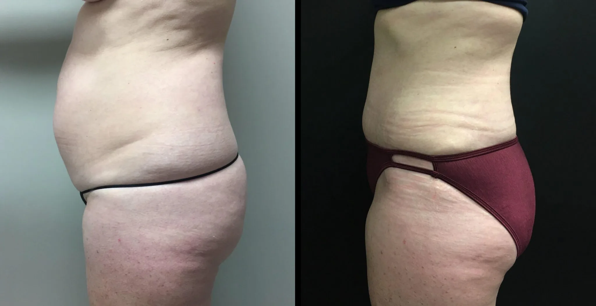 Tummy Tuck Before & After Case Number 00025