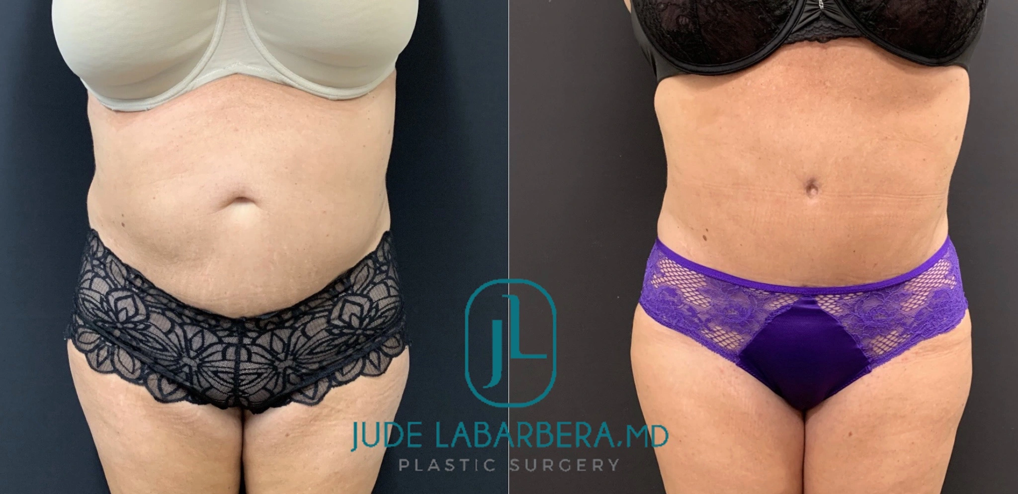 Tummy Tuck Before & After Case Number 0003