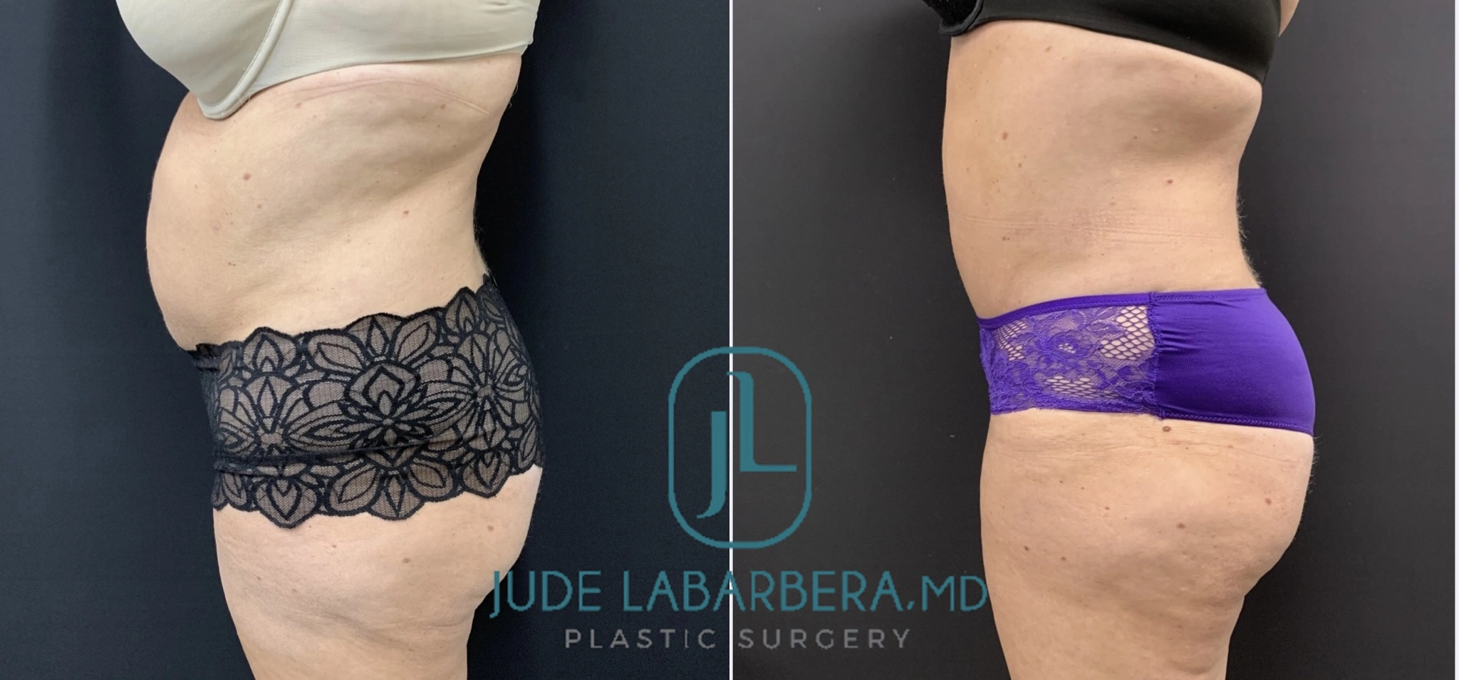 Tummy Tuck Before & After Case Number 0003