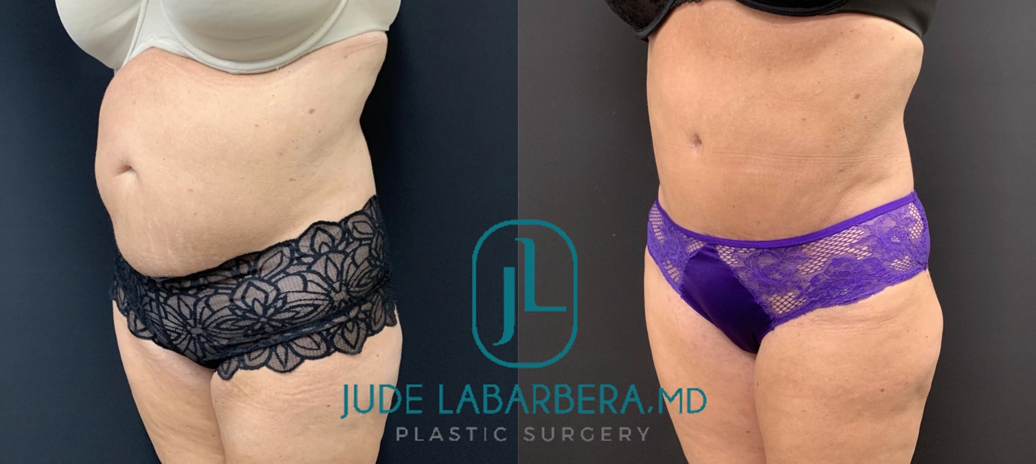 Tummy Tuck Before & After Case Number 0003