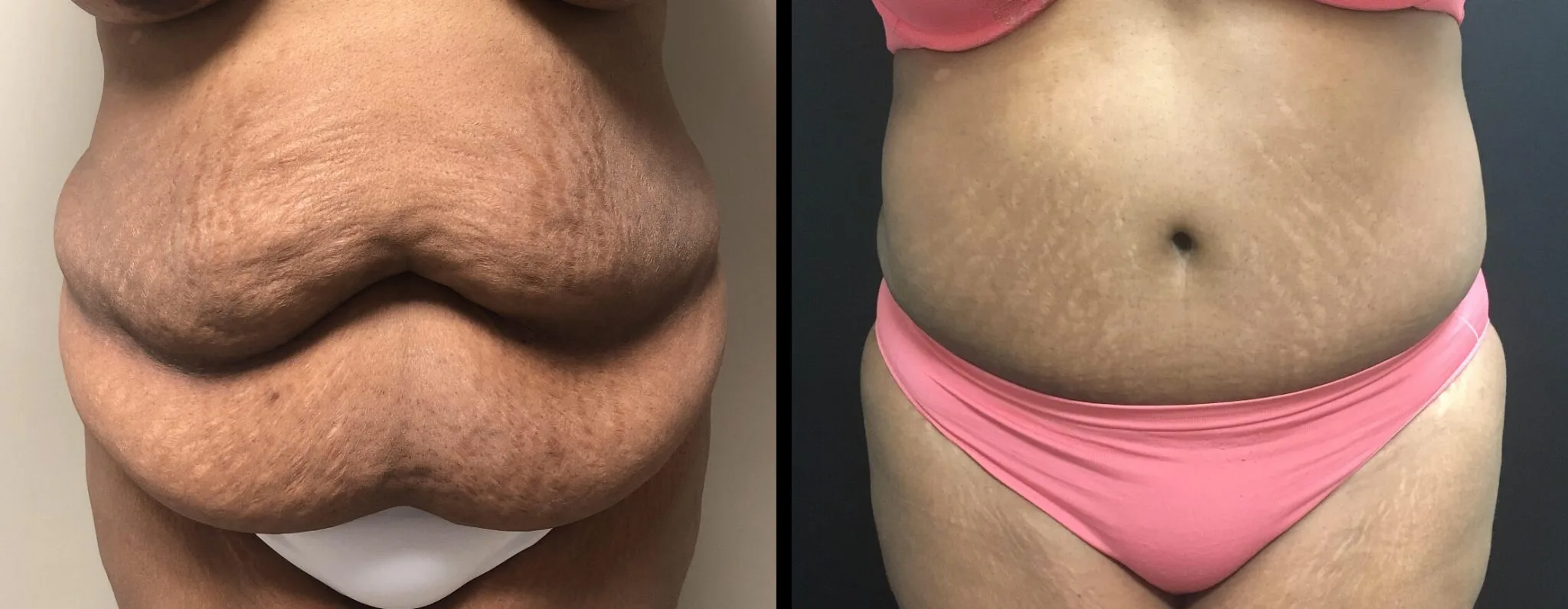 Tummy Tuck Before & After Case Number 00030