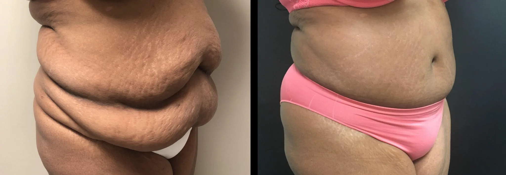 Tummy Tuck Before & After Case Number 00030