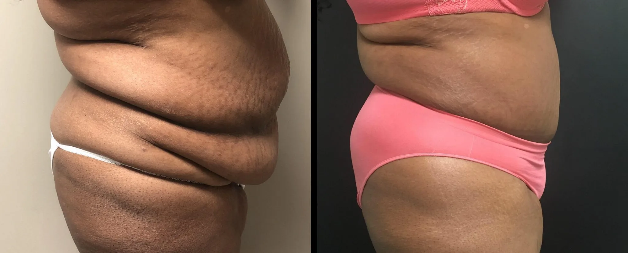 Tummy Tuck Before & After Case Number 00030