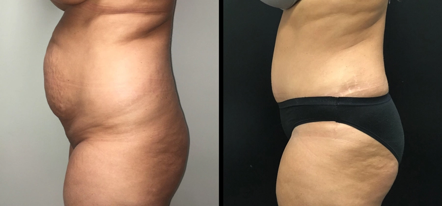 Tummy Tuck Before & After Case Number 00032