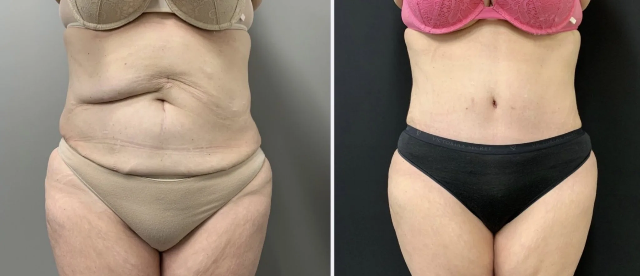Tummy Tuck Before & After Case Number 00035
