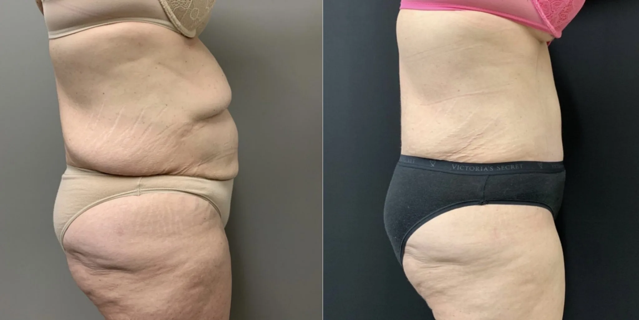 Tummy Tuck Before & After Case Number 00035