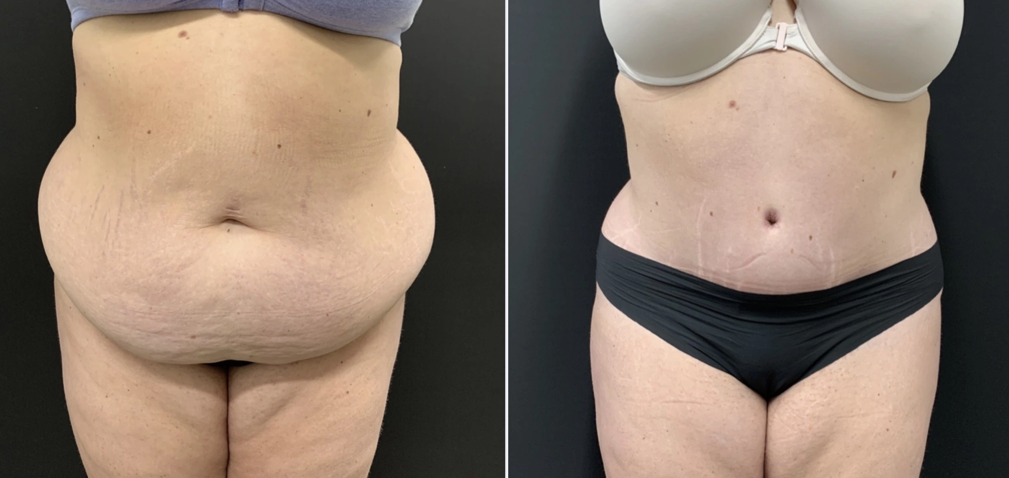 Tummy Tuck Before & After Case Number 00043