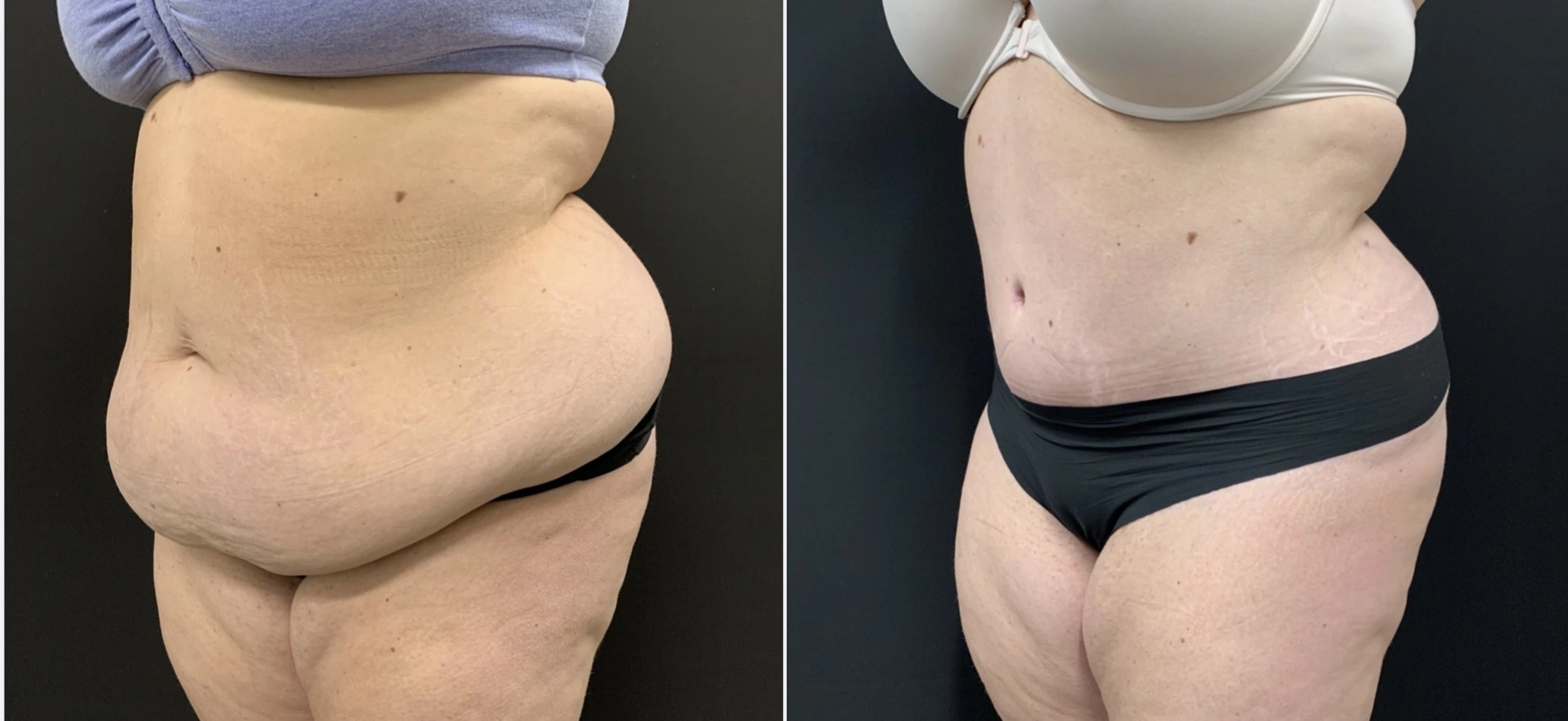 Tummy Tuck Before & After Case Number 00043