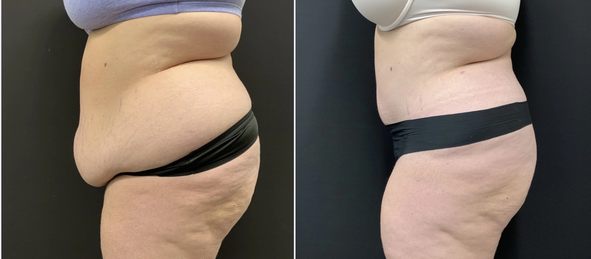 Tummy Tuck Before & After Case Number 00043