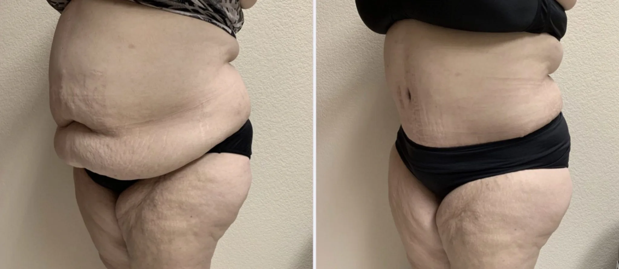 Tummy Tuck Before & After Case Number 00044