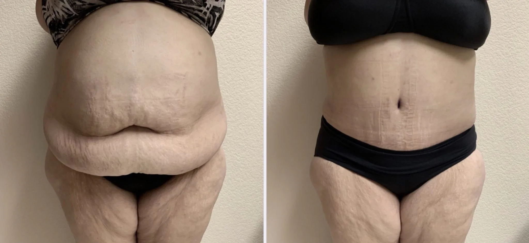 Tummy Tuck Before & After Case Number 00044