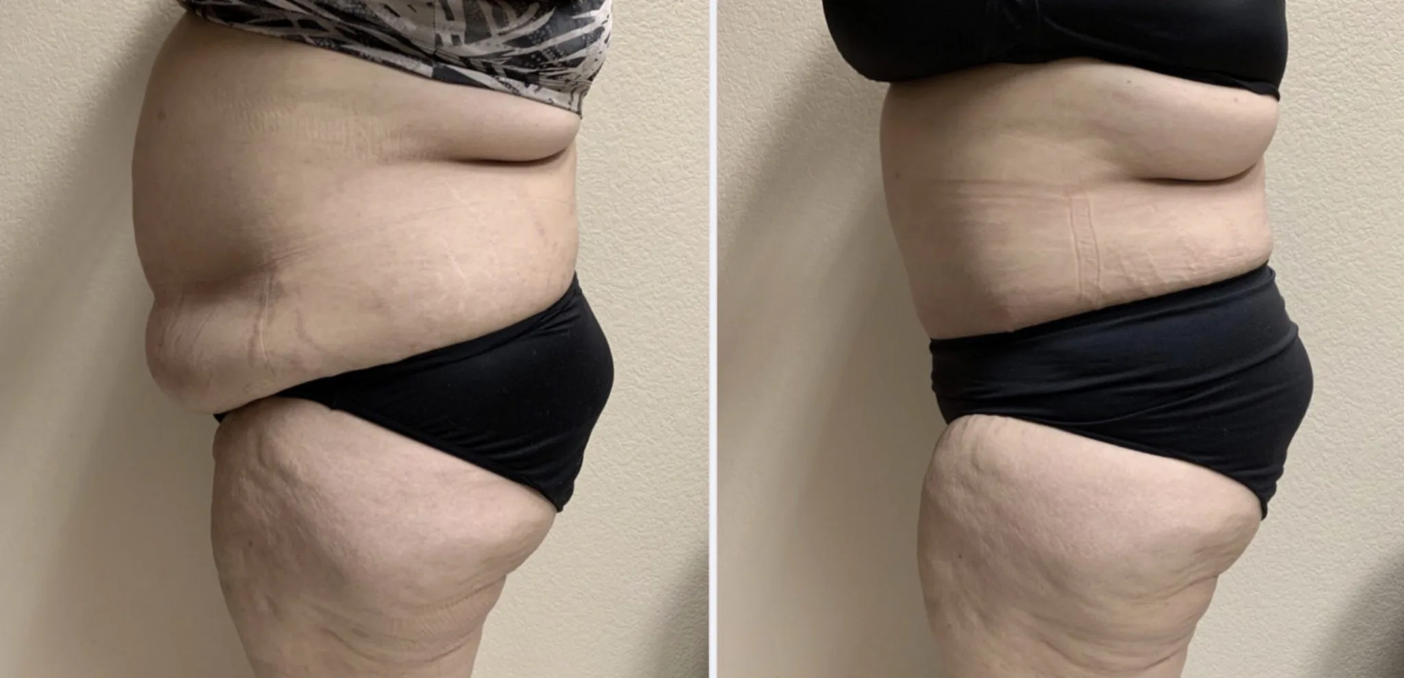Tummy Tuck Before & After Case Number 00044