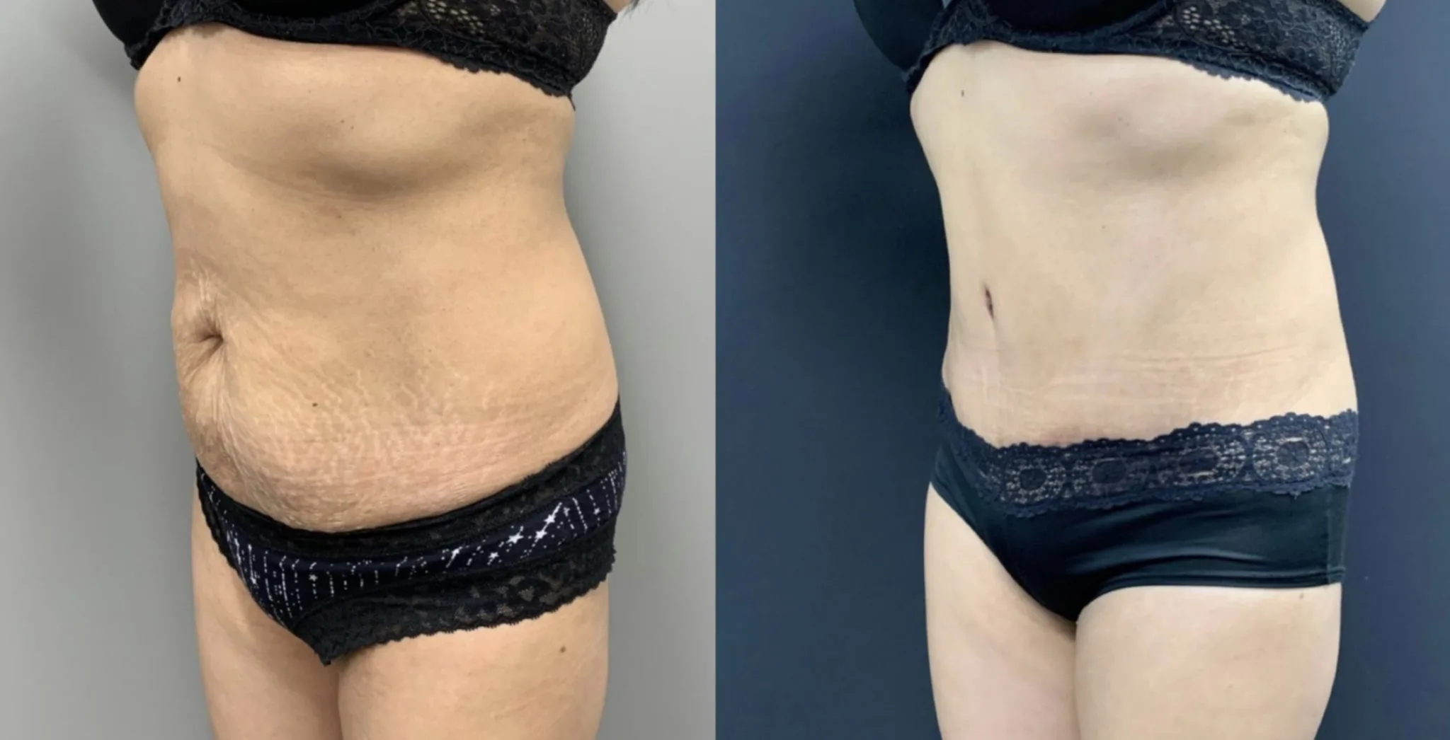 Tummy Tuck Before & After Case Number 00045