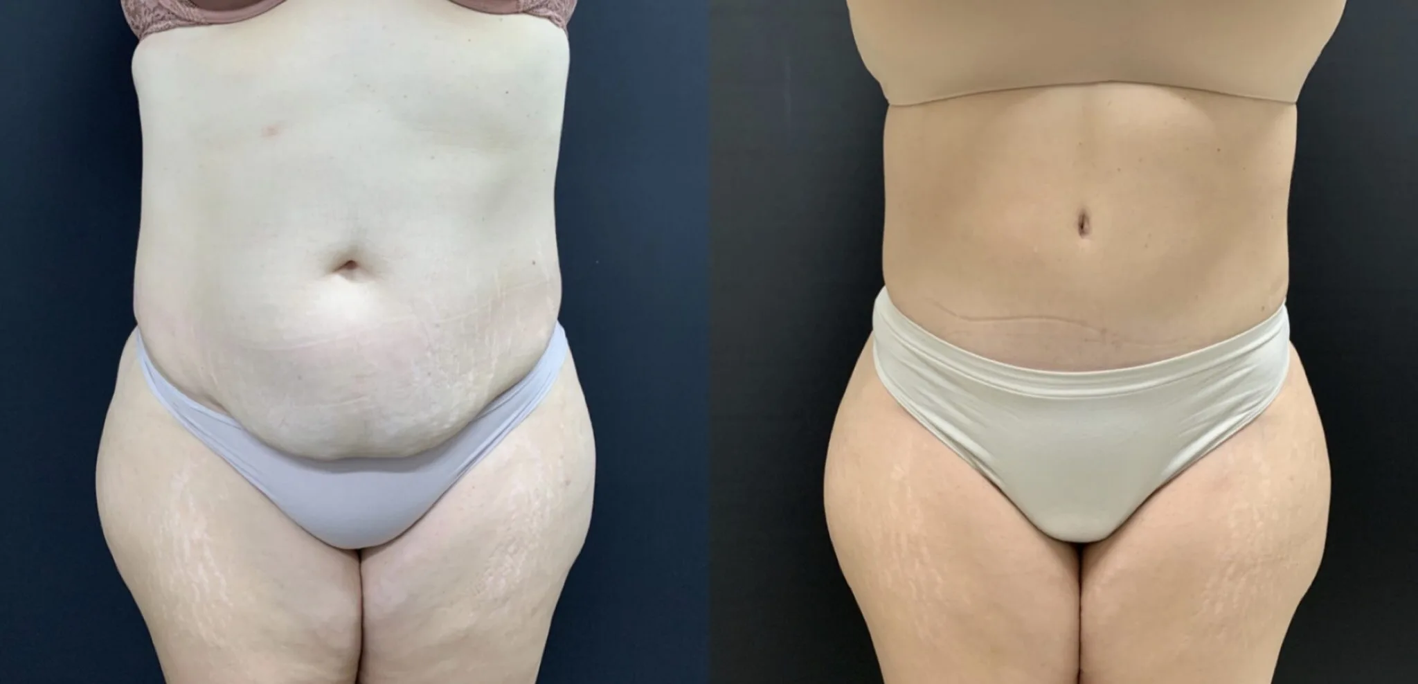 TUMMY TUCK Before & After Case Number 00052